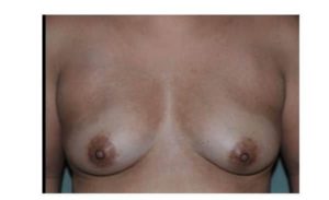 before front view breast augmentation female patient case 1841