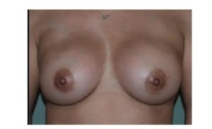 after front view breast augmentation female patient case 1841