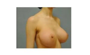 after right view breast augmentation female patient case 1844