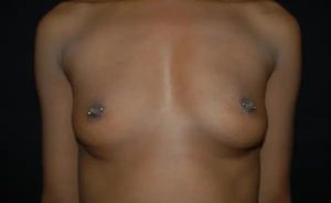 before front view breast augmentation female patient case 1850