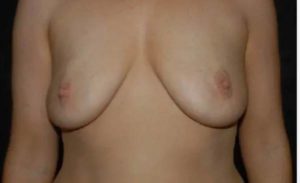 before front view breast augmentation female patient case 1879