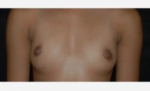 before front view breast augmentation female patient case 1892