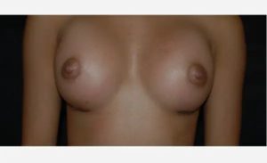 after front view breast augmentation female patient case 1892