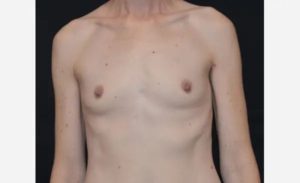 before front view breast augmentation male patient case 1907