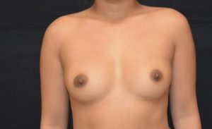 before front view breast augmentation female patient case 1911
