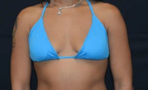 before front view breast augmentation female patient case 1934