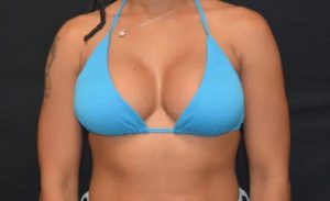 after front view breast augmentation female patient case 1934