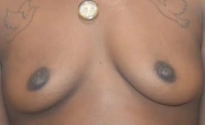 before front view breast augmentation female patient case 1942