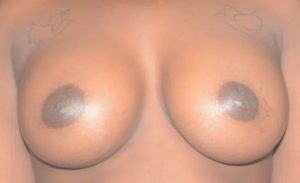 after front view breast augmentation female patient case 1942