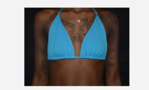 before front view breast augmentation female patient case 1966
