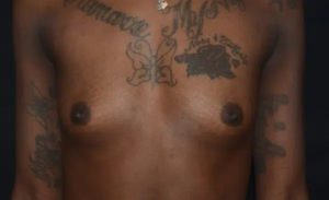 before front view breast augmentation female patient case 1971