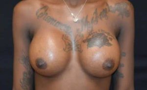 after front view breast augmentation female patient case 1971