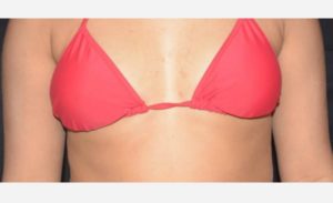before front view breast augmentation female patient case 1989