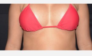 after front view breast augmentation female patient case 1989