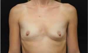before front view breast augmentation female patient case 1998