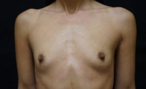 before breast augmentation front view female case 2052