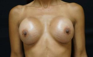 after breast augmentation front view female case 2052