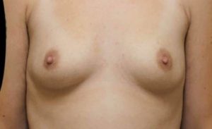 before breast augmentation front view female patient case 2069