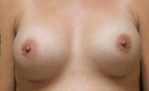 after breast augmentation front view female patient case 2069