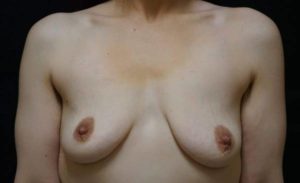 before breast augmentation front view female patient case 2079
