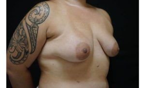 before breast augmentation right view female patient case 2082