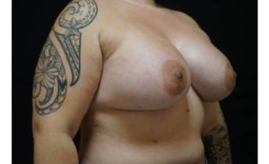 after breast augmentation right view female patient case 2082