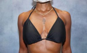 before breast augmentation front view female patient case 2087