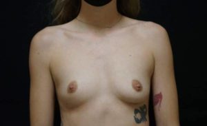 before breast augmentation front view female patient case 2097