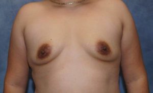 before breast augmentation front view female patient case 2159