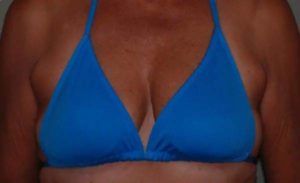 before breast augmentation front view case 2600