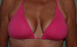 after breast augmentation front view case 2600