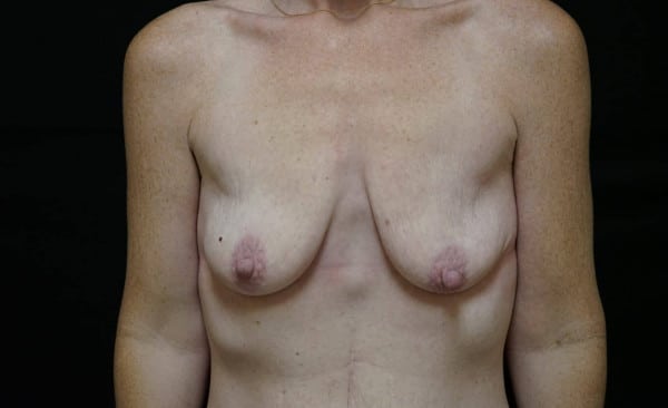 Before Breast Lift Female Patient Front Angle View Case 1310