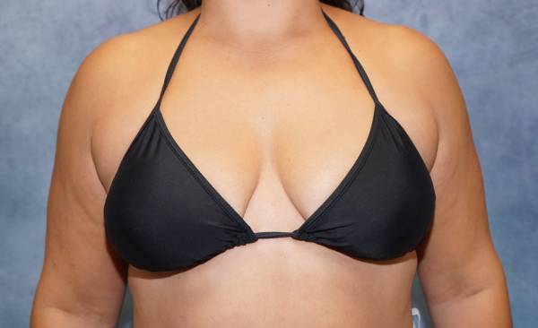 Before Breast Lift Female Patient Clothed Angle View Case 1313