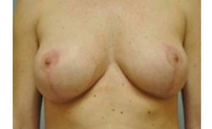 after breast reduction front view case 2630