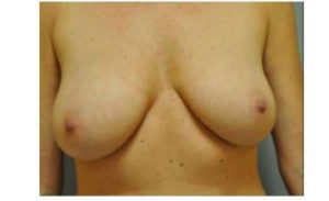 before breast reduction front view case 2630