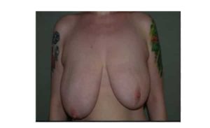 before breast reduction front view case 2633