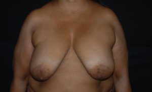 before breast reduction front view case 2636