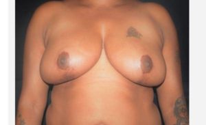 after breast reduction front view case 2642