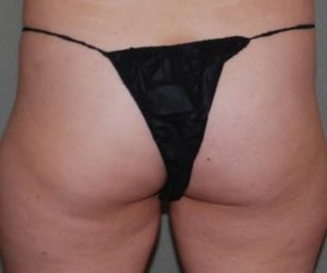 Before Butt Lift Case 1616