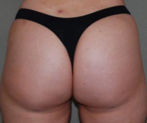 After Butt Lift Case 1616