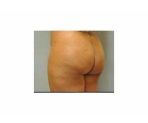 Before Butt Lift Female Patient Diagonal Angle View Case 1624