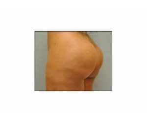 After Butt Lift Female Patient Diagonal Angle View Case 1624