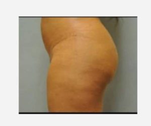 Before Butt Lift Female Patient Side Angle View Case 1627