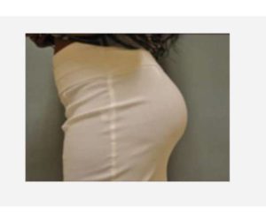 After Butt Lift Female Patient Side Angle View Case 1627