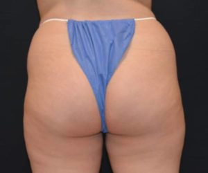 Before Butt Lift Case 1633