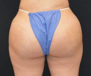 After Butt Lift Case 1633