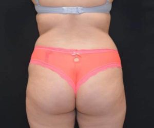 Before Butt Lift Female Patient Back Angle View Case 1646