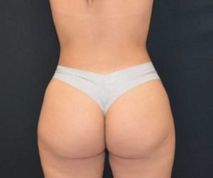 After Butt Lift Female Patient Back Angle View Case 1646
