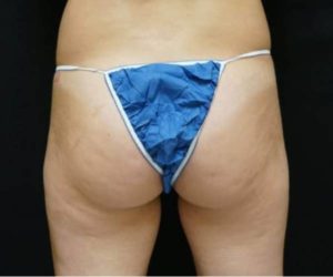 Before Butt Lift Female Patient Back Angle View Case 1655