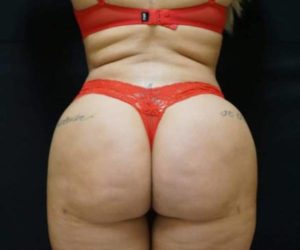After Butt Lift Female Patient Back Angle View Case 1664